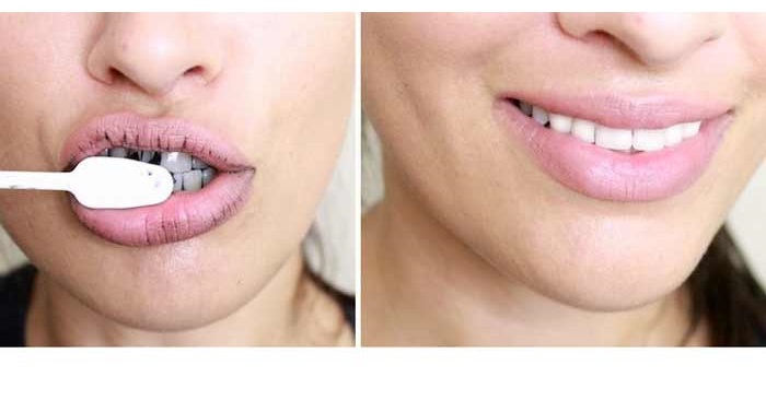 Teeth whitening in 2 tones