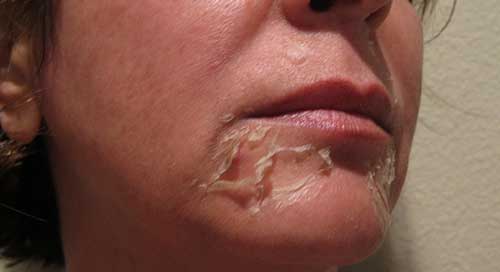 Chemical peeling of the face