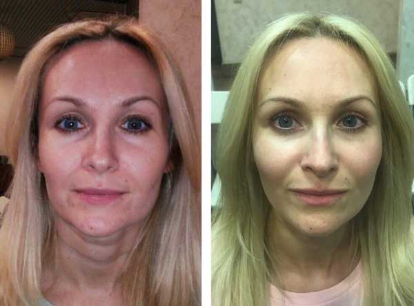 Before and after facelift training