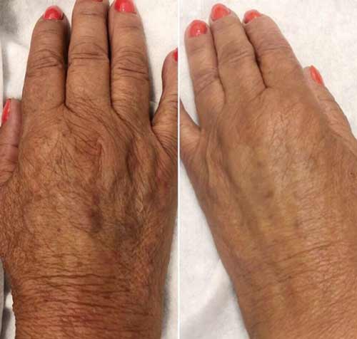 Photorejuvenation of the skin of the hands